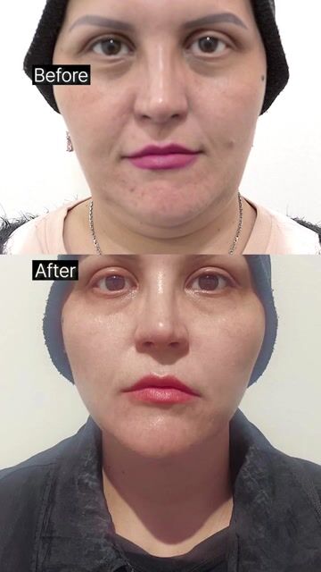 Density Lifting at ELEV Clinic